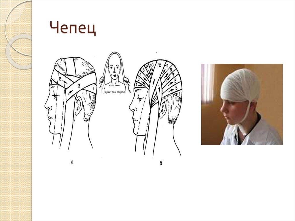 Повязка чепец. Десмургия чепец. Повязка на голову десмургия чепец. Чепчик десмургия. ЧМТ чепец.