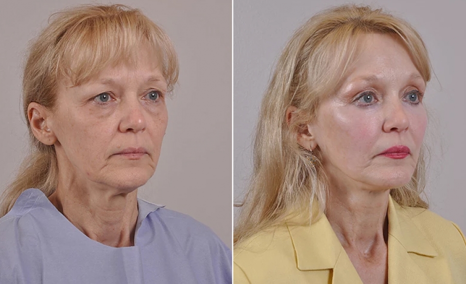 Липофилинг носогубных складок фото до и после